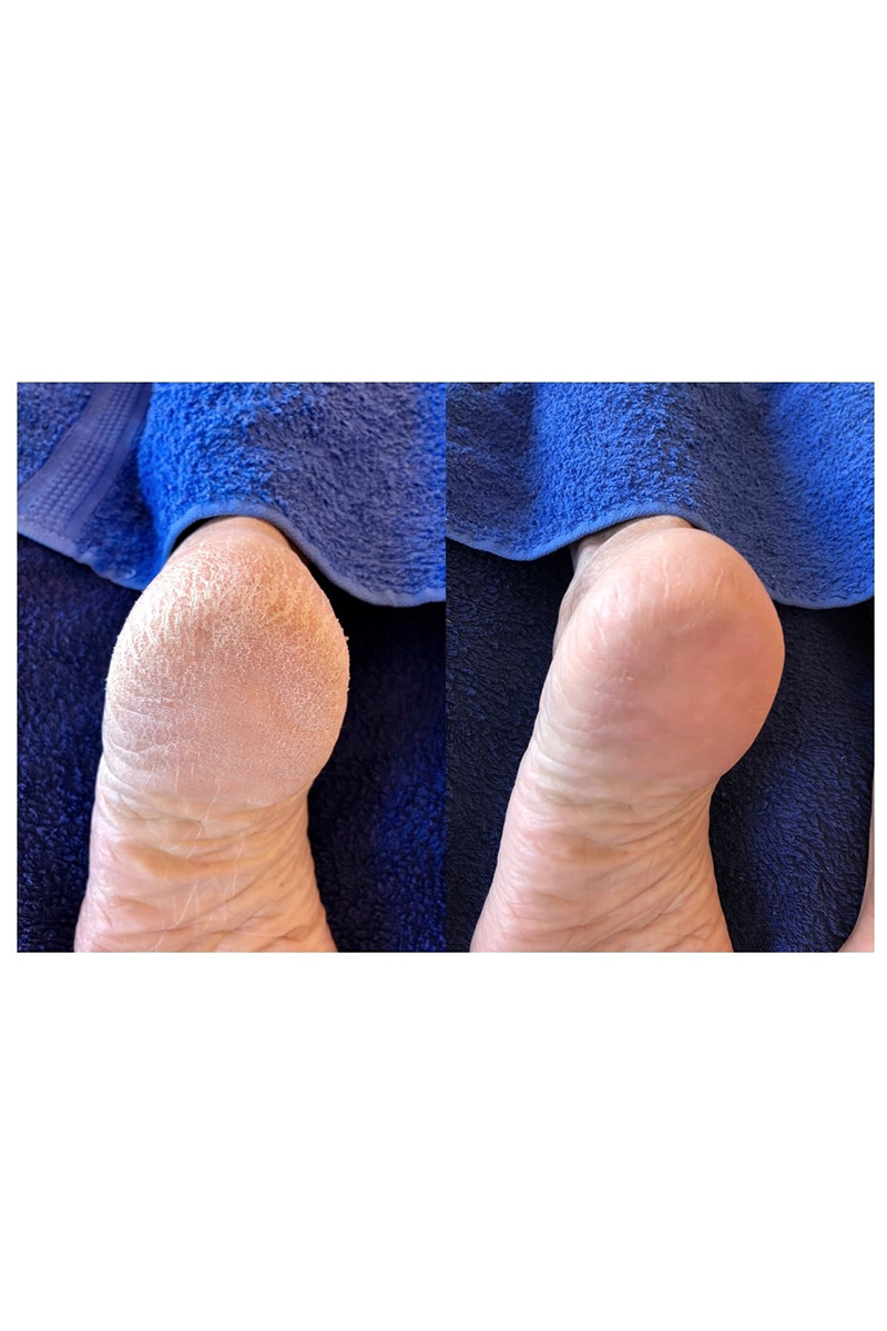 LOVA SKIN Instant Foot Peeling Spray Diversen-4 4